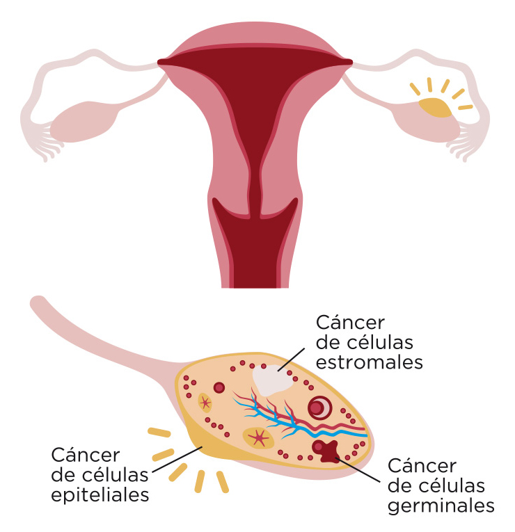 cancer-ovario