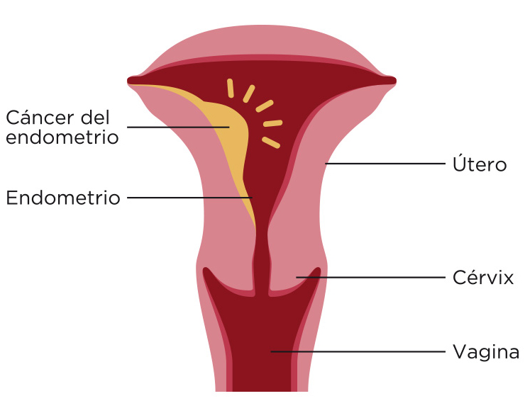 cancer-utero